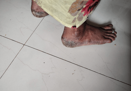 A women's feet - bruised and with dry skin